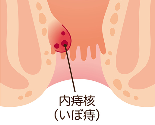 内痔核