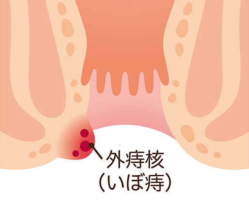 外痔核
