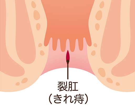 切れ痔
