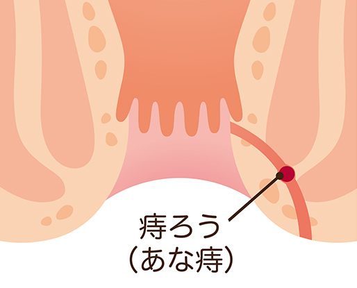 痔ろう(あな痔)