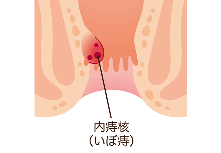内痔核