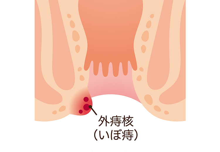 外痔核