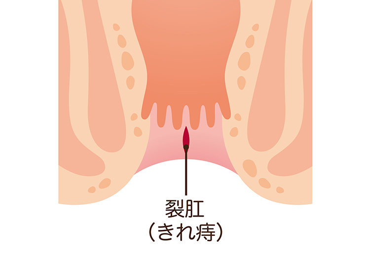 切れ痔