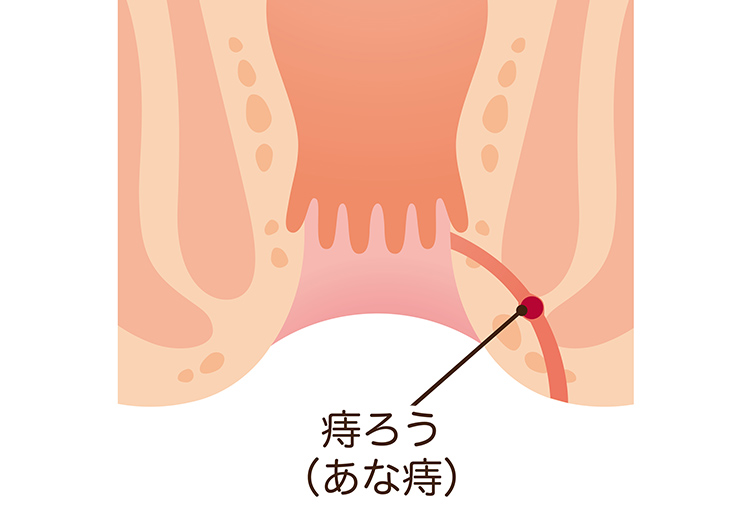 痔ろう(あな痔)